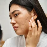 Acne Prone Skin Combo - Image 2
